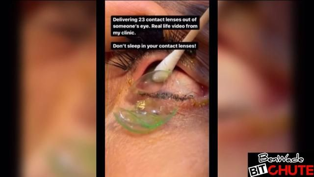 Don’t Sleep with Contacts! Eye Doc Removes 23 Contacts From 1 Eye