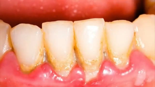 The 1 Top Remedy for Dental Plaque Cavities and Gingivitis
