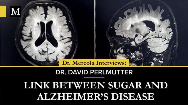 Dr. Mercola Interviews Dr. David Perlmutter on the Link Between Sugar and Alzheimers Disease