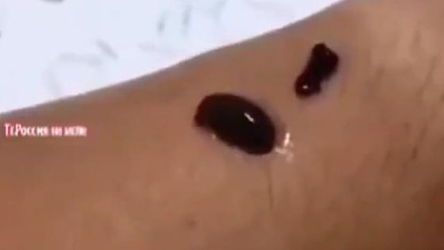 Leeches die 3 days after feeding on COVID VACCINATED BLOOD. (Experiment from Japan).