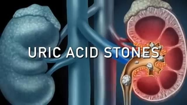 Clean Your Kidneys of Uric Acid and Oxalates