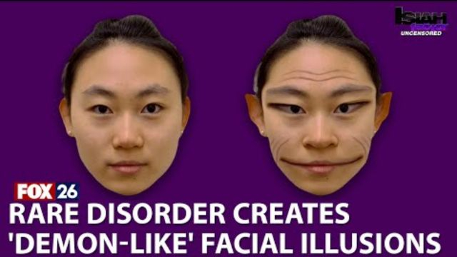 Rare 'demon face' syndrome