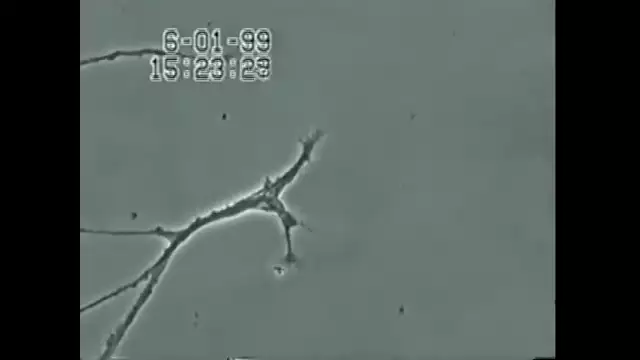 Brain Neuron Degeneration Caused By Mercury (this is your brain on vaccines-toxins)