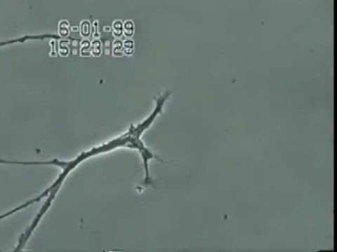 Brain Neuron Degeneration Caused By Mercury (this is your brain on vaccines-toxins)