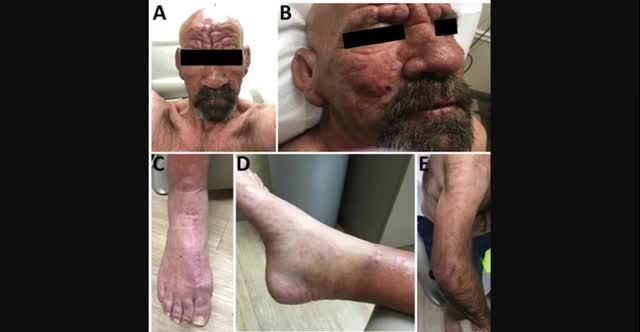 Alarming Surge of Leprosy Cases in Central Florida - What You Need to Know