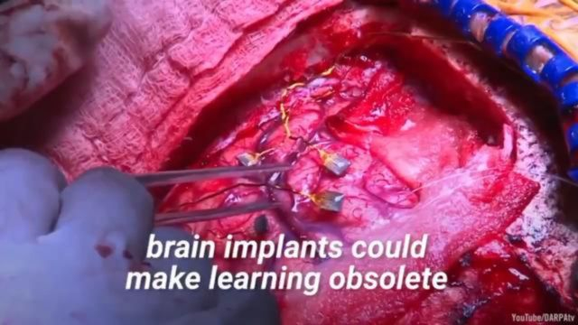 Brain implants for all after the year 2030